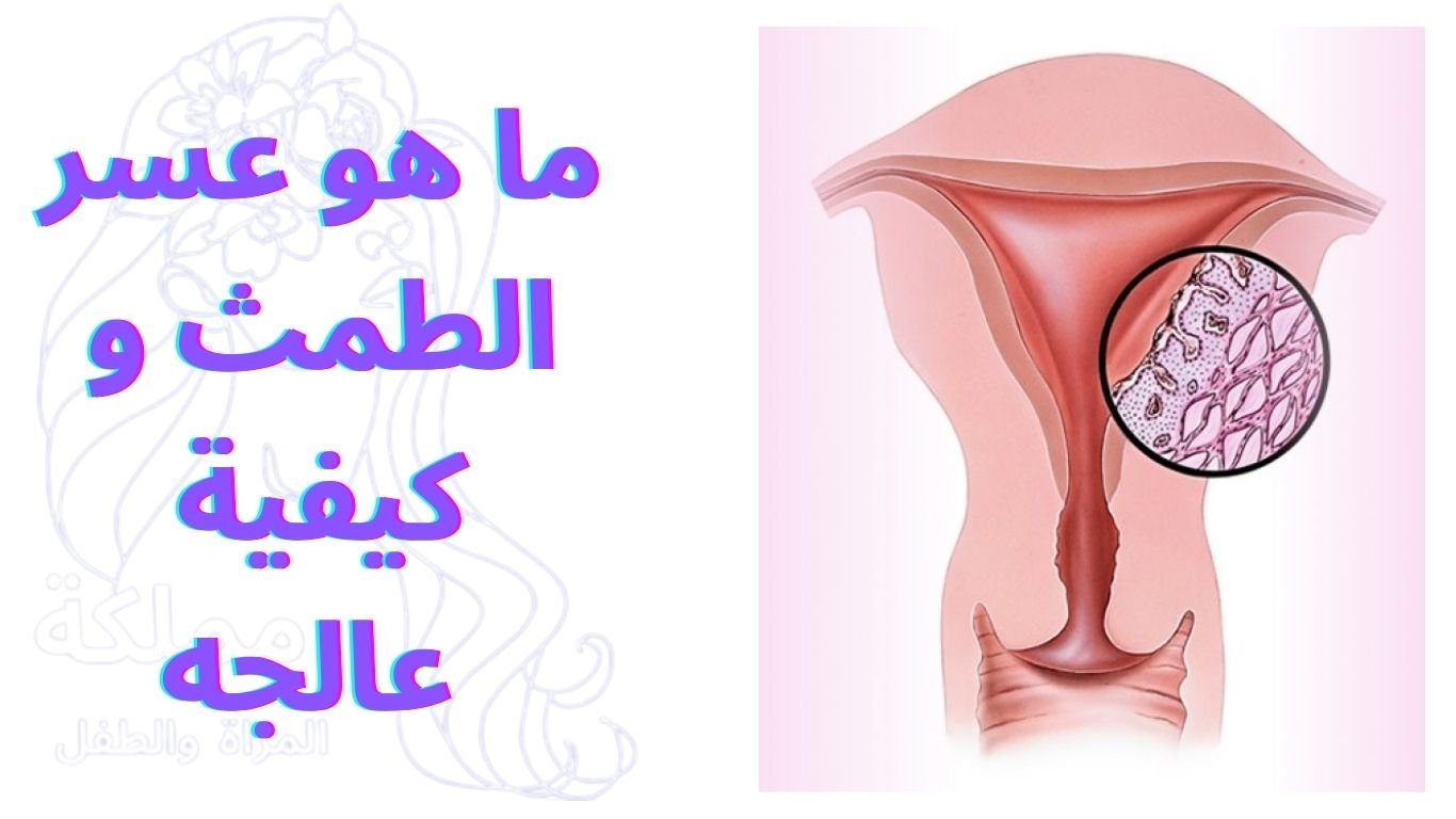 ما هو عسر الطمث و كيفية عالجه | Dysmenorrhea