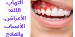 التهاب اللثة: الأعراض، الأسباب والعلاج