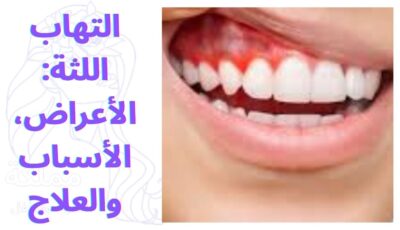 التهاب اللثة: الأعراض، الأسباب والعلاج