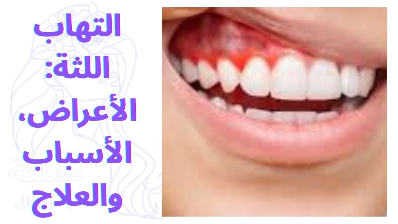 التهاب اللثة: الأعراض، الأسباب والعلاج