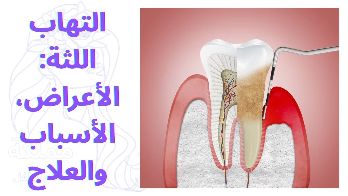 التهاب اللثة: الأعراض، الأسباب والعلاج