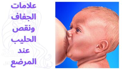 علامات الجفاف ونقص الحليب عند المرضع