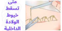متى تسقط خيوط الولادة الداخلية