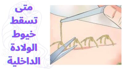 متى تسقط خيوط الولادة الداخلية