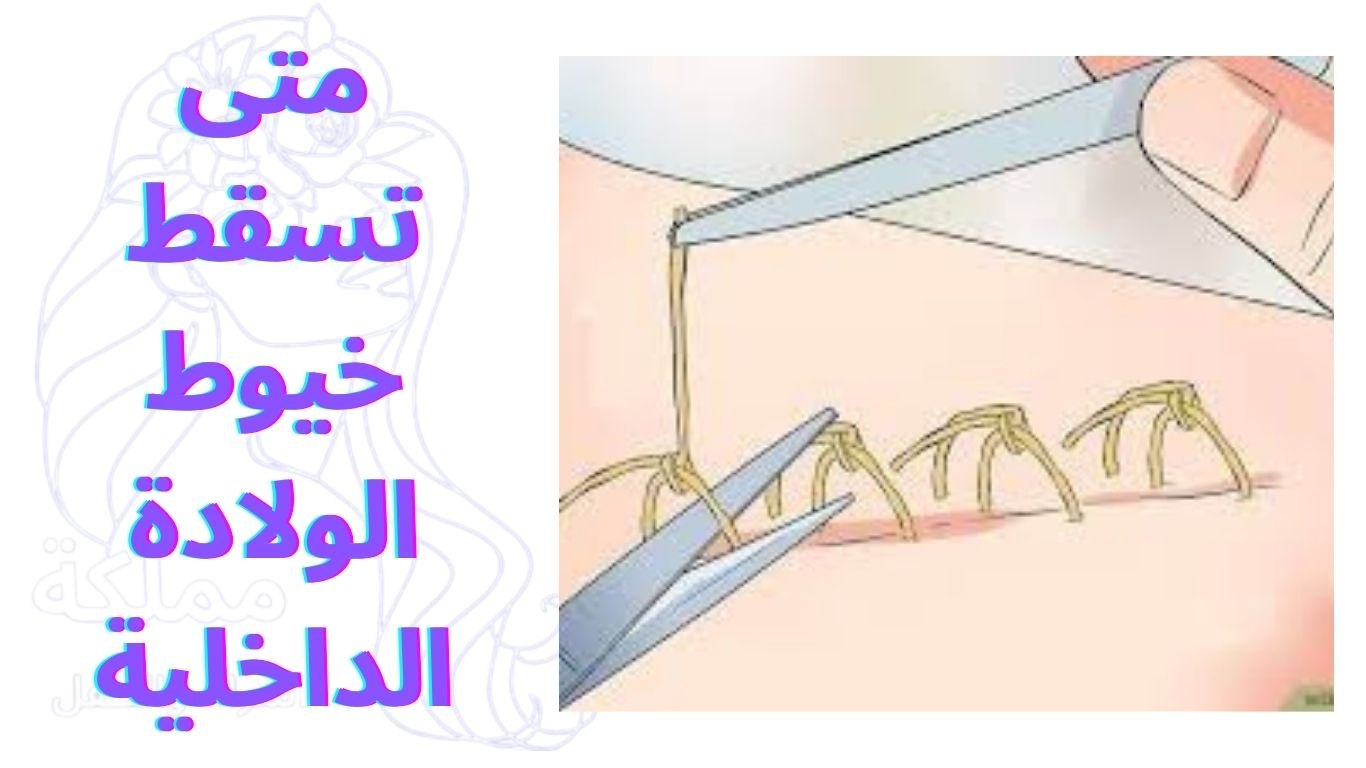 متى تسقط خيوط الولادة الداخلية