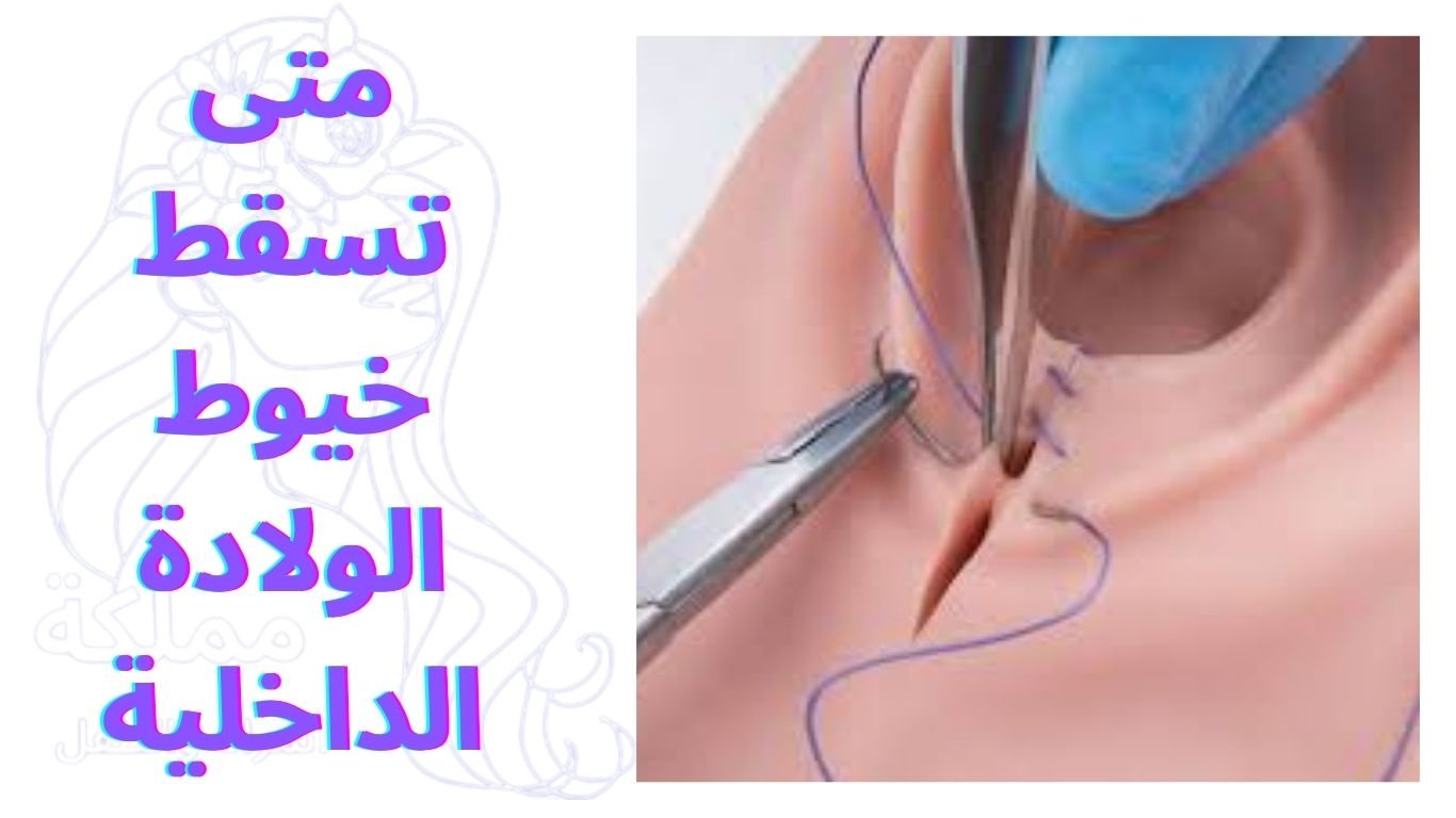 متى تسقط خيوط الولادة الداخلية
