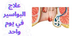 علاج البواسير في يوم واحد