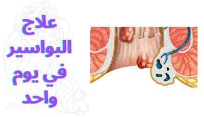 علاج البواسير في يوم واحد
