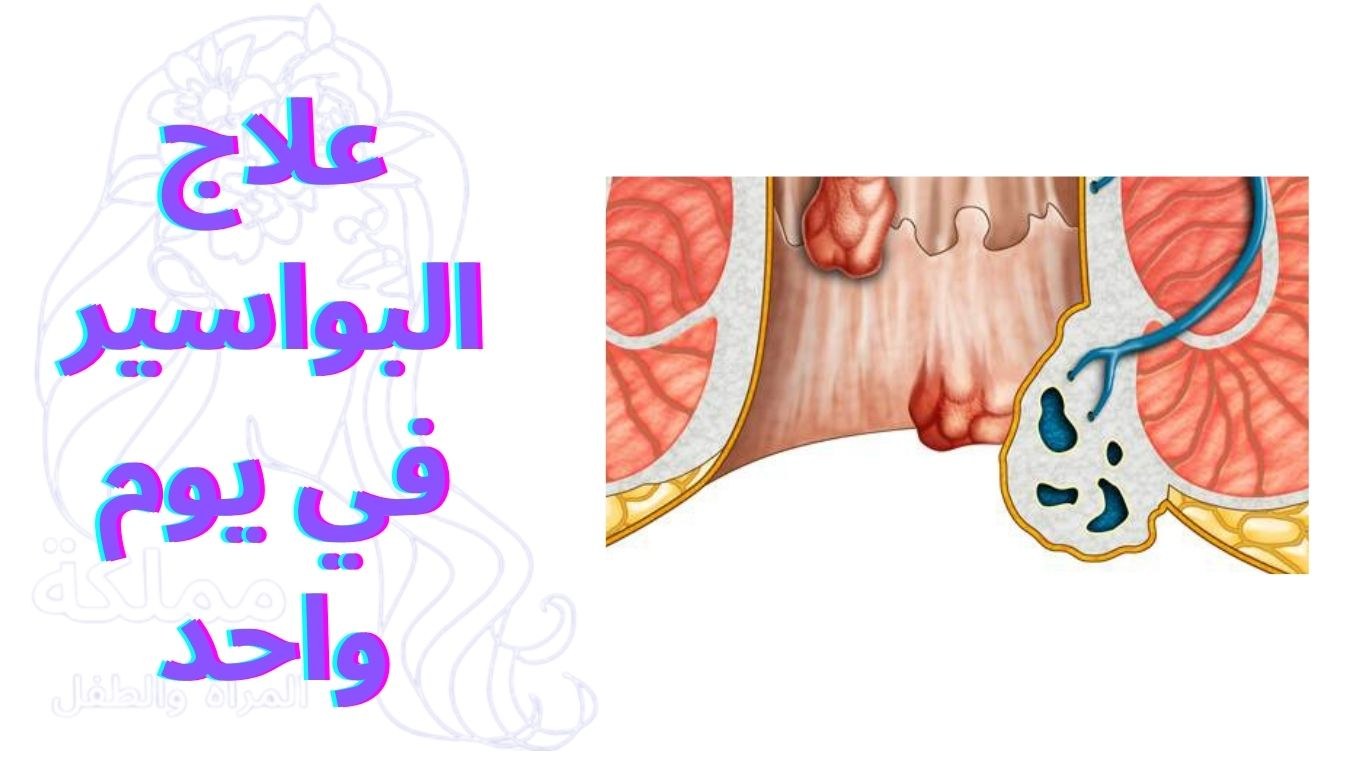 علاج البواسير في يوم واحد