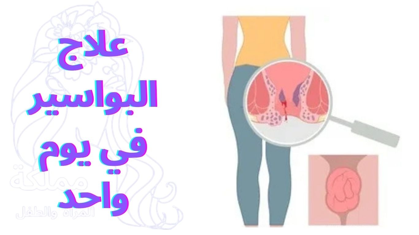 علاج البواسير في يوم واحد