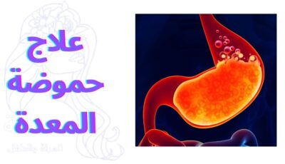 علاج حموضة المعدة