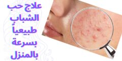 علاج حب الشباب طبيعياً بسرعة بالمنزل