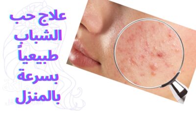 علاج حب الشباب طبيعياً بسرعة بالمنزل