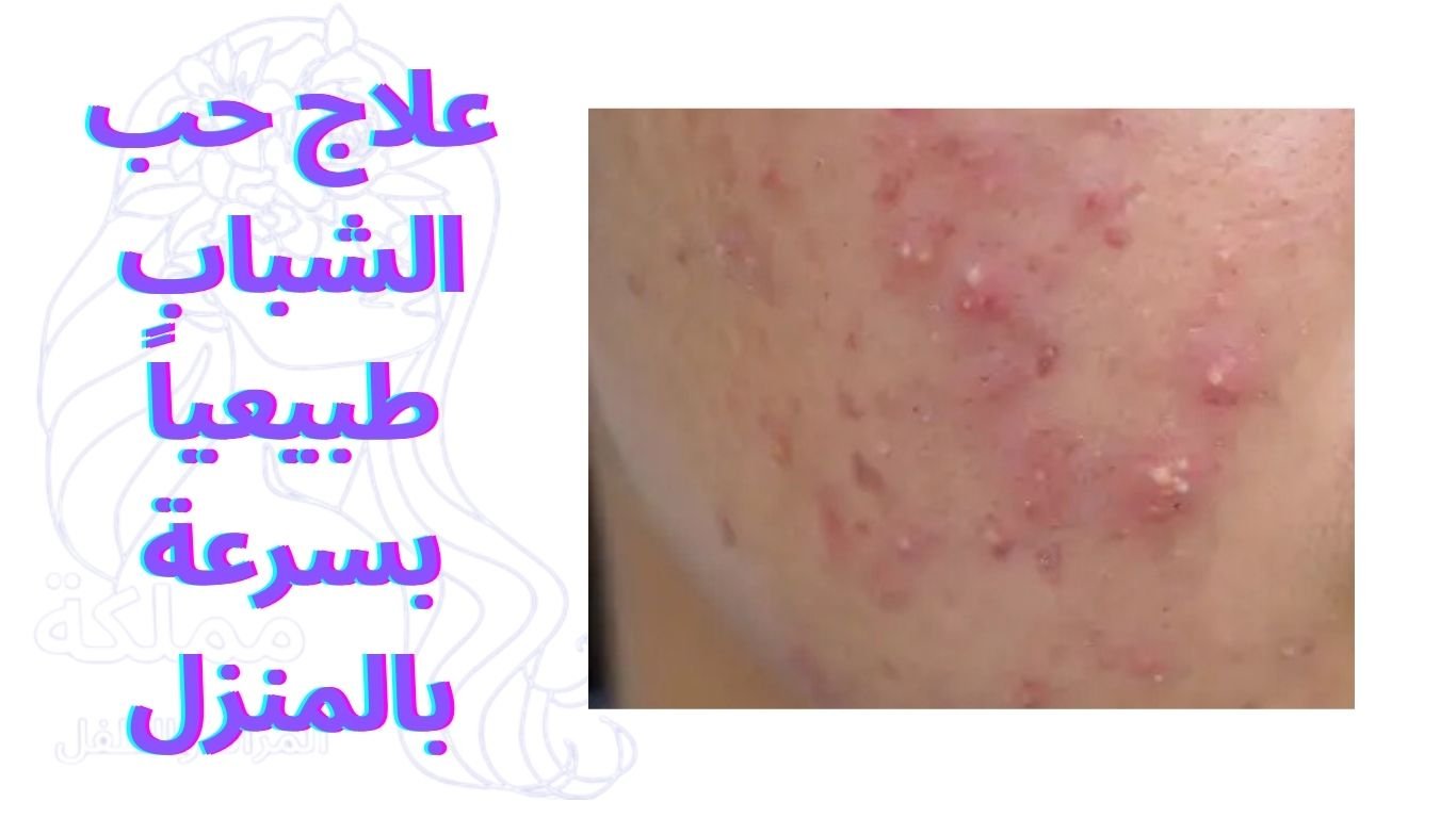 علاج حب الشباب طبيعياً بسرعة بالمنزل