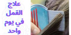 علاج القمل في يوم واحد