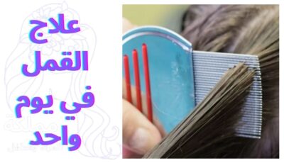 علاج القمل في يوم واحد