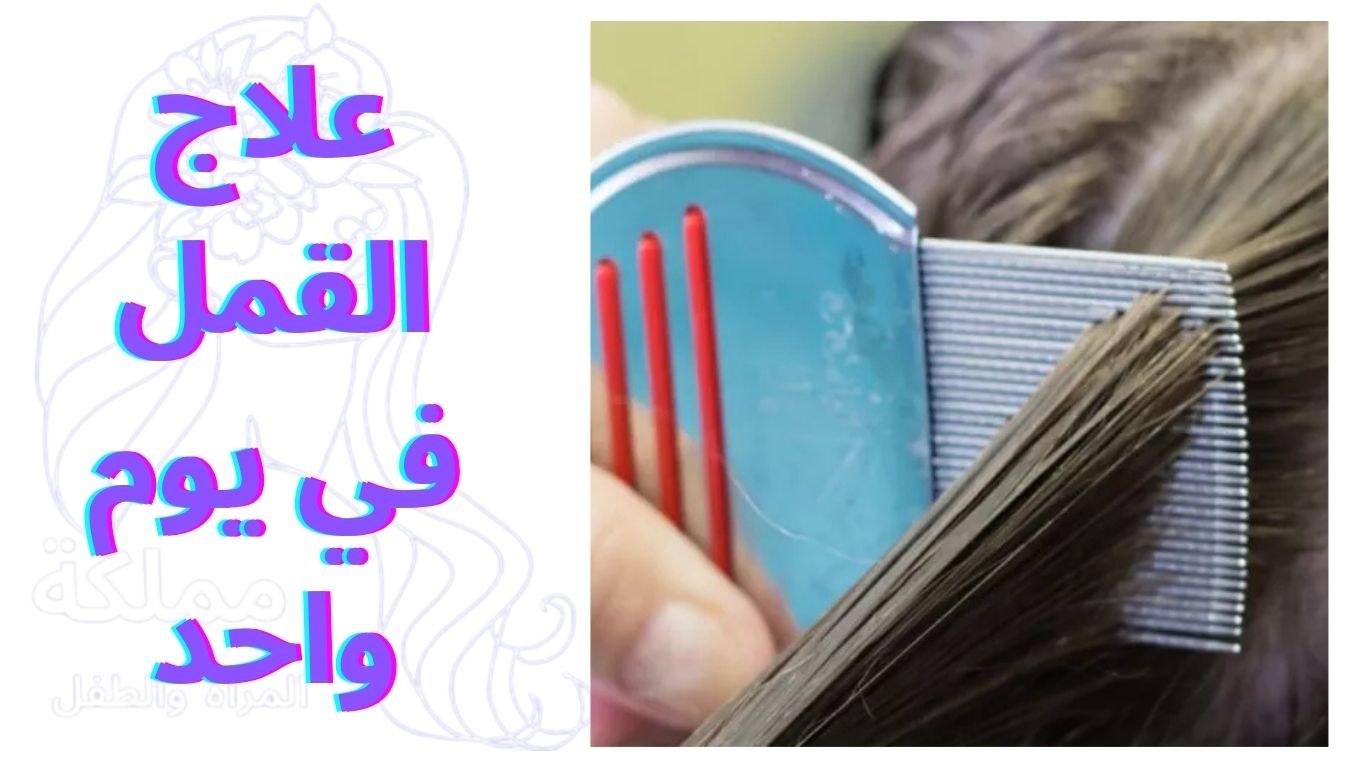 علاج القمل في يوم واحد