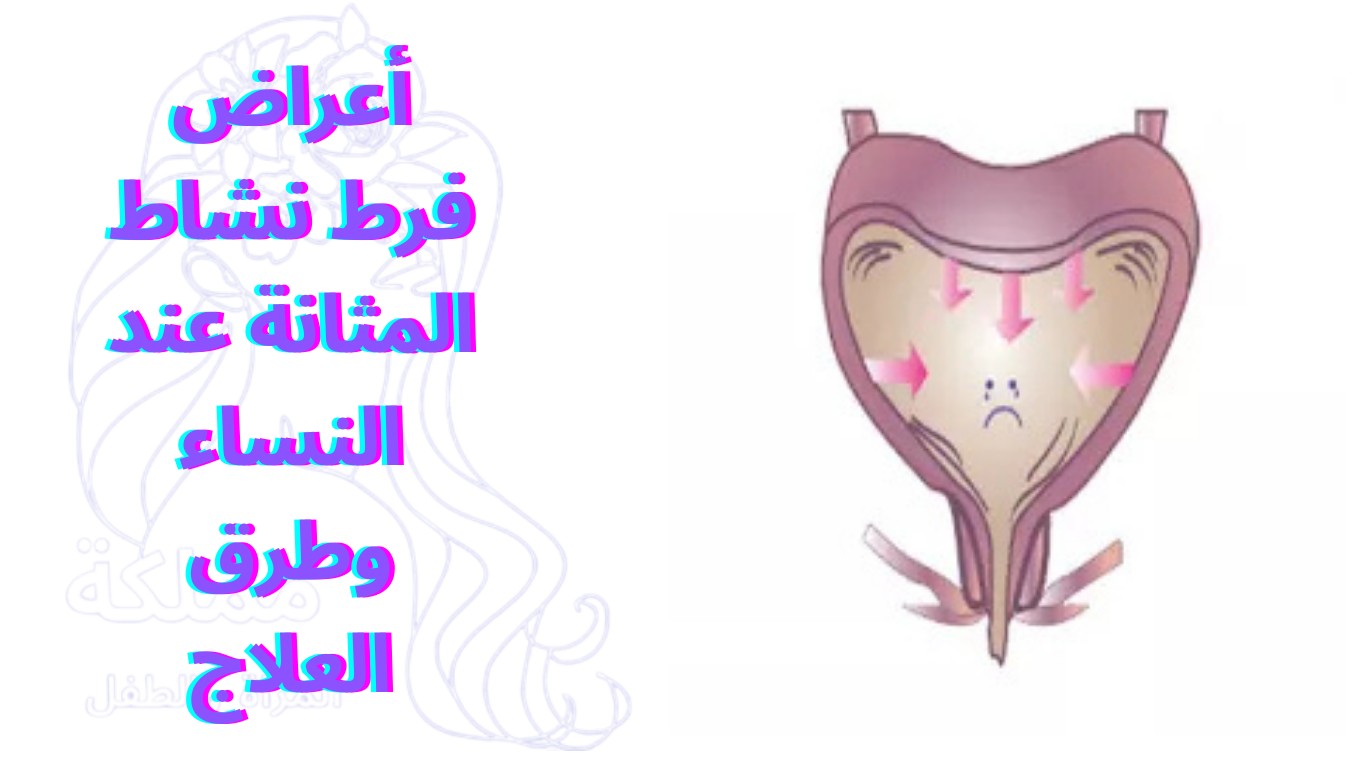 أعراض فرط نشاط المثانة عند النساء وطرق العلاج