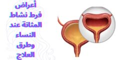 أعراض فرط نشاط المثانة عند النساء وطرق العلاج