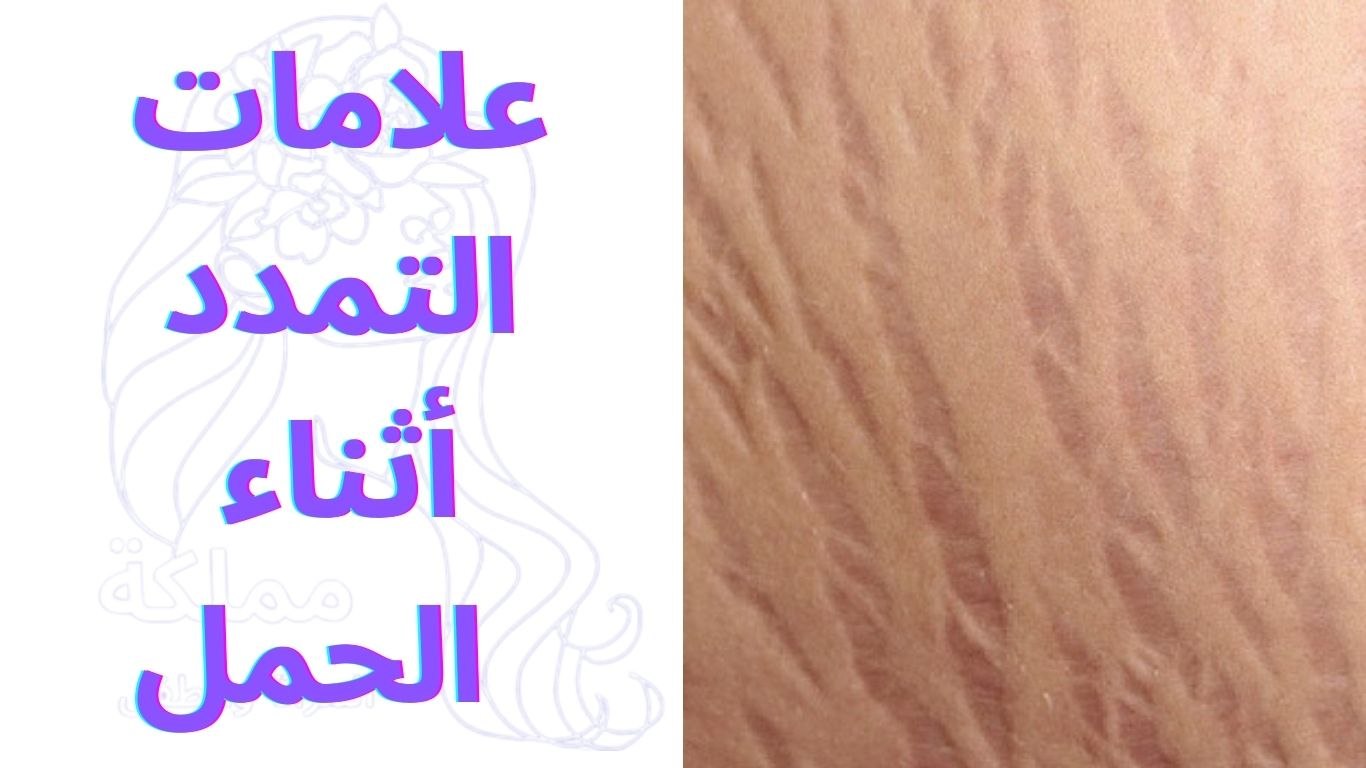 علامات التمدد أثناء الحمل | Stretch marks during pregnancy