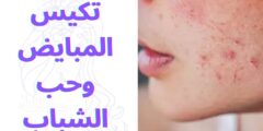 تكيس المبايض وحب الشباب