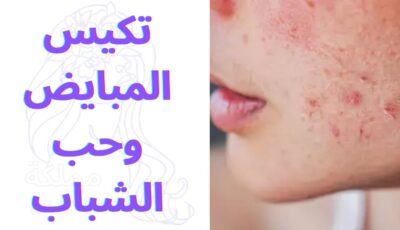 تكيس المبايض وحب الشباب