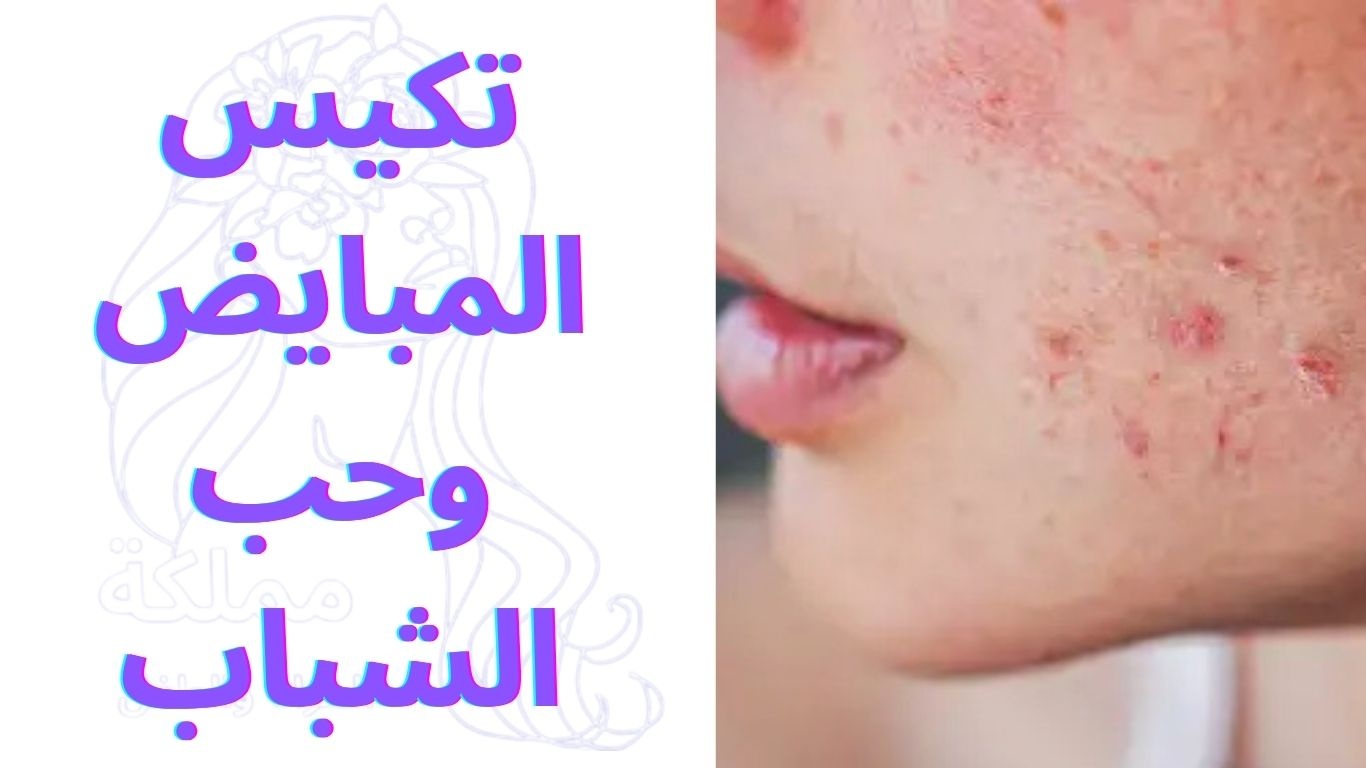 تكيس المبايض وحب الشباب