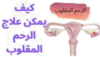 كيف يمكن علاج الرحم المقلوب