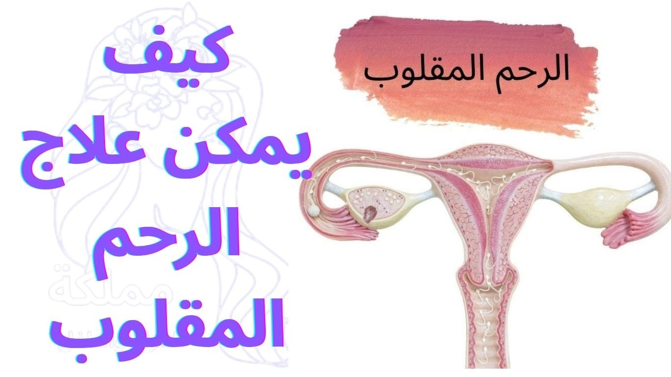 كيف يمكن علاج الرحم المقلوب