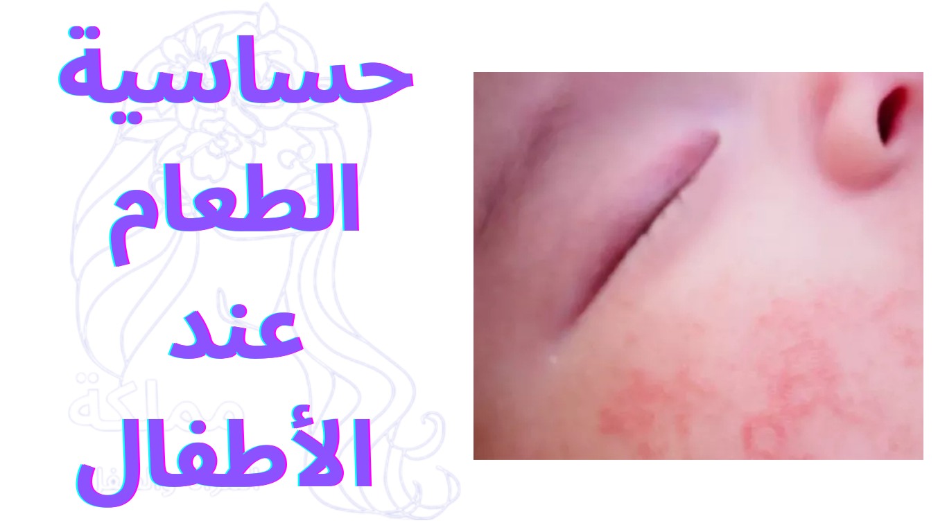 حساسية الطعام عند الأطفال